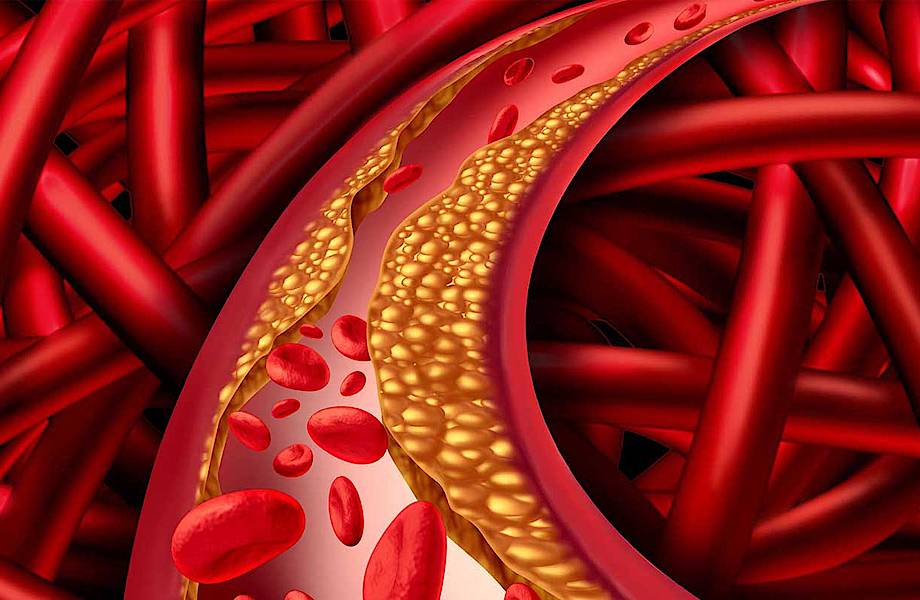 Почему холестерин не опасен для жителей Крайнего Севера Почему холестерин не опасен для жителей Крайнего Севера